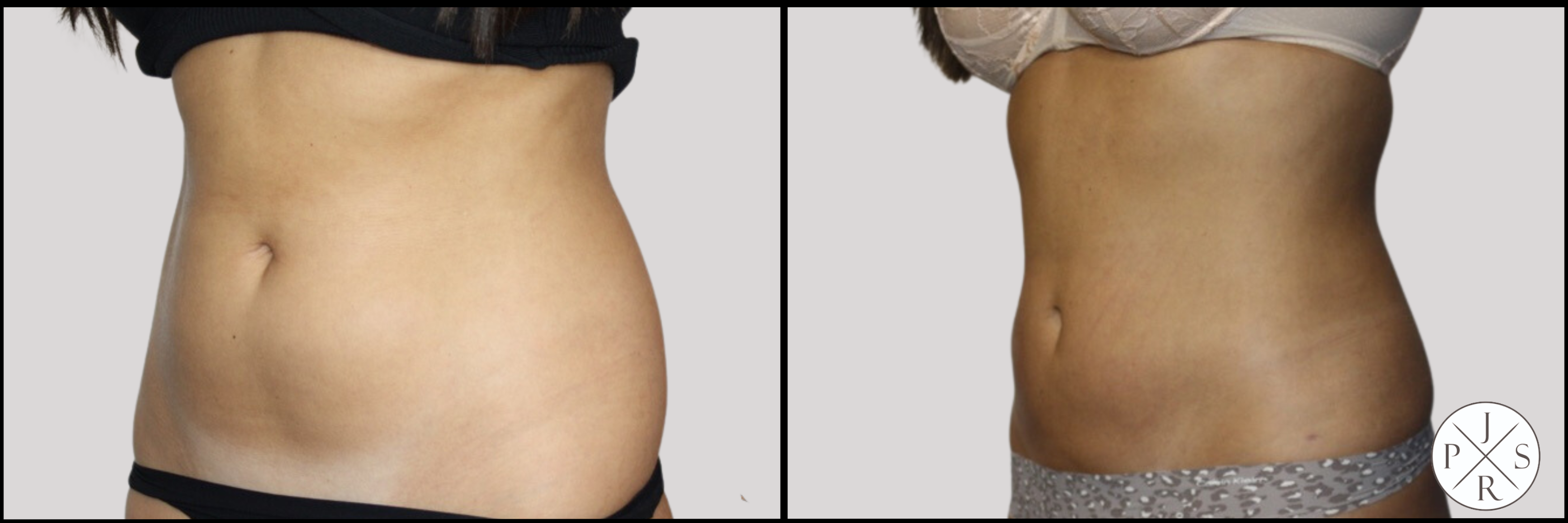 Liposuction Before & After Image